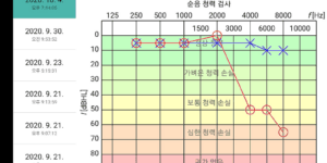 돌발성 난청 어지럼증